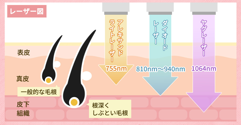 レーザー種類