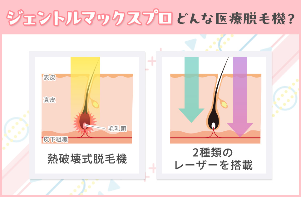 ジェントルマックスプロはどんな脱毛機？