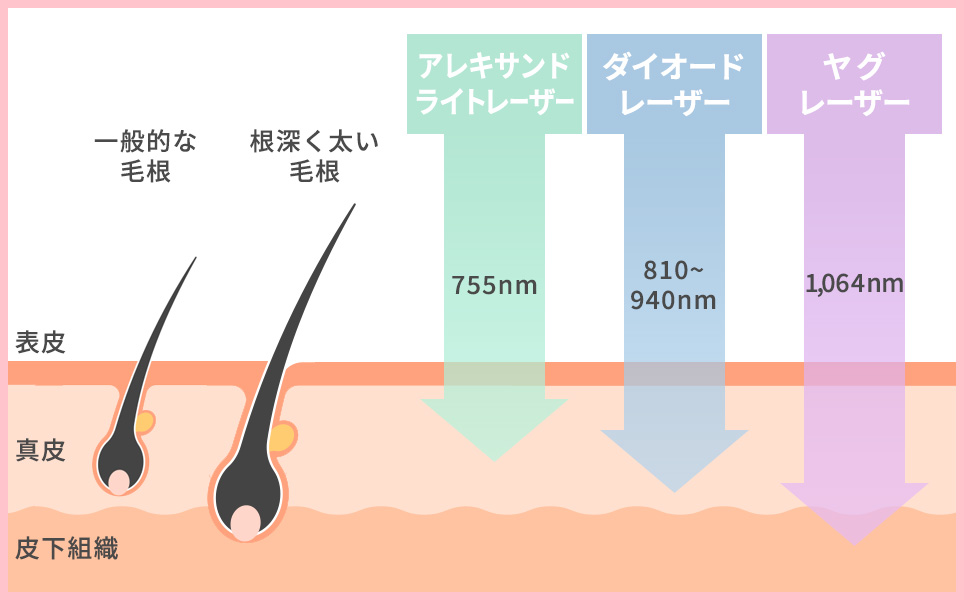 3つの医療レーザーの特徴まとめ