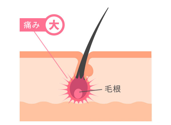 毛根に働きかける熱破壊式のイラスト