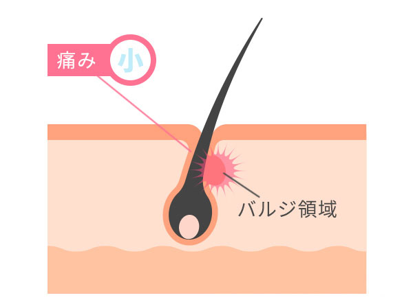 バルジ領域に働きかける蓄熱式のイラスト