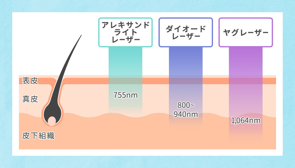 3つのレーザーの深達性のイラスト