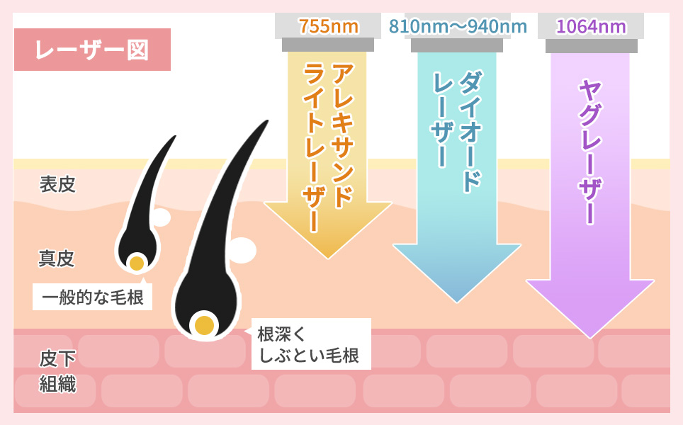 船橋の熱破壊式医療脱毛のレーザー