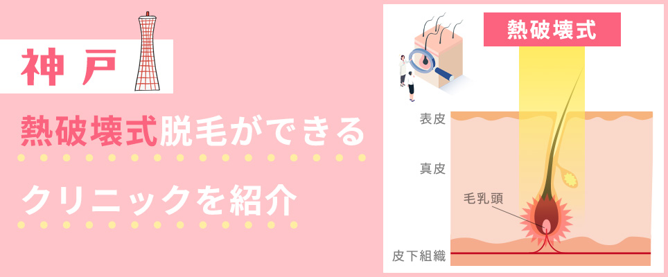 神戸で熱破壊式脱毛機取り扱いクリニックを紹介