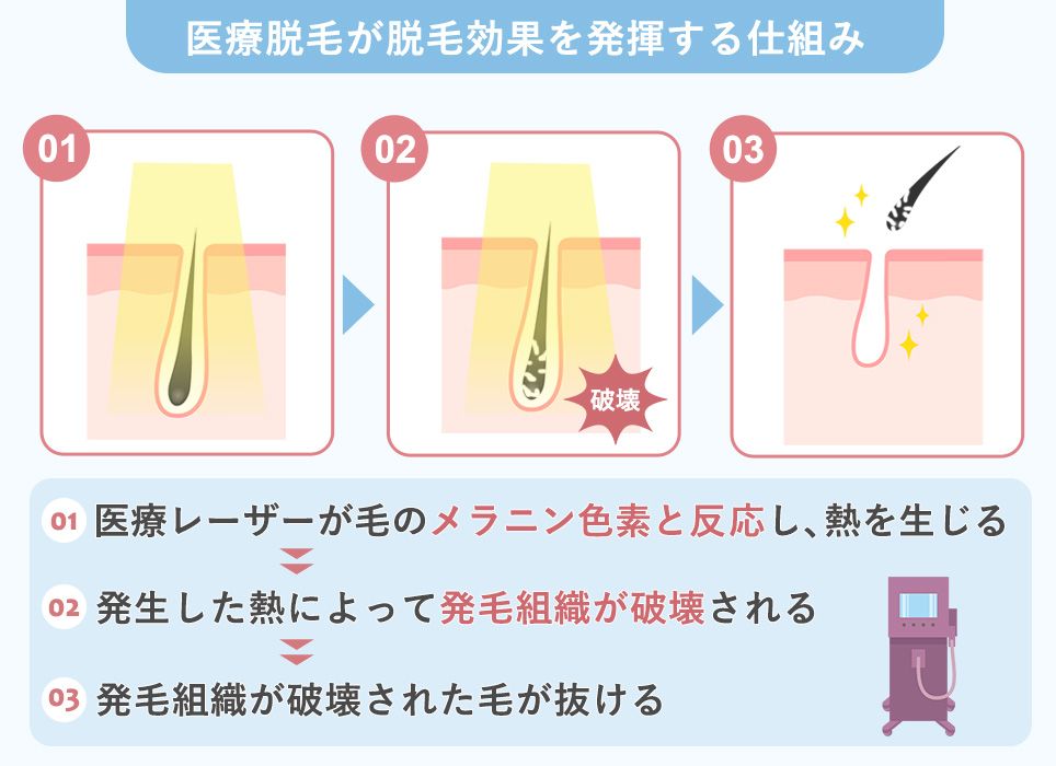 医療脱毛の施術が脱毛効果を発揮する仕組み