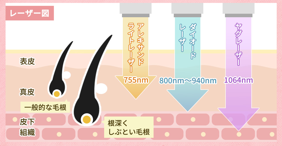 レーザーの種類