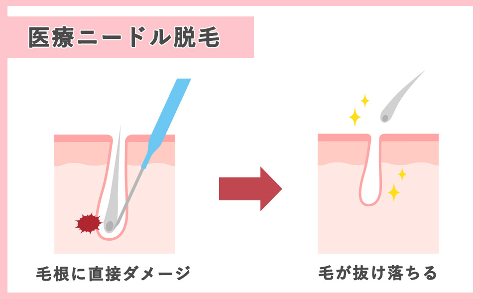 医療ニードル脱毛