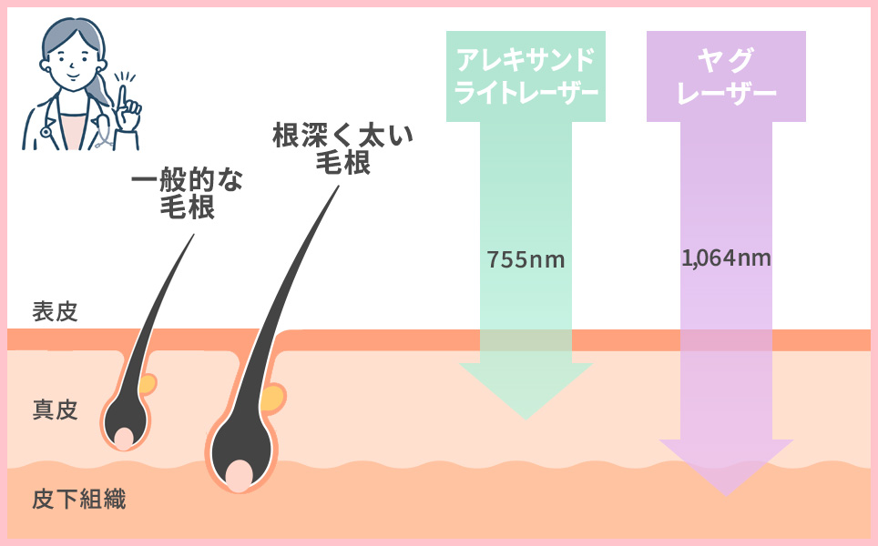 アレキサンドライトレーザーとヤグレーザーの図説