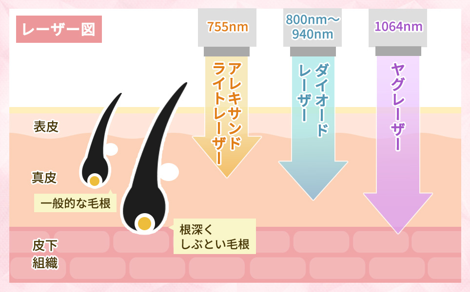 レーザーの種類