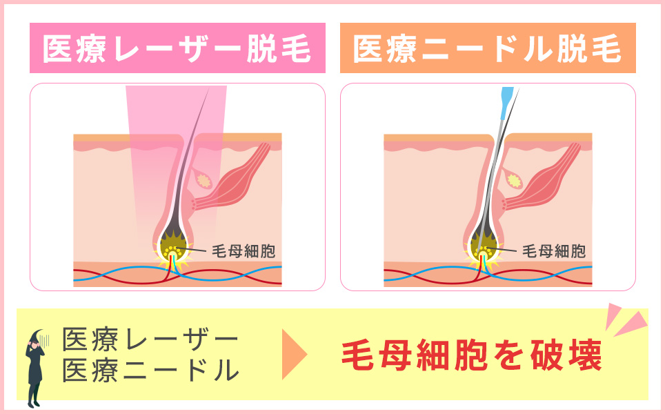 医療レーザー、ニードル脱毛の特徴