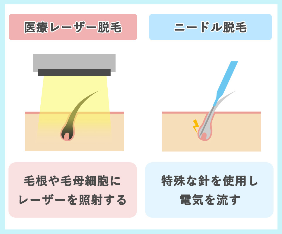 医療レーザーと医療ニードル脱毛の図説