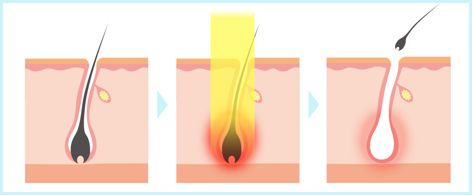 脱毛の仕組みの図説