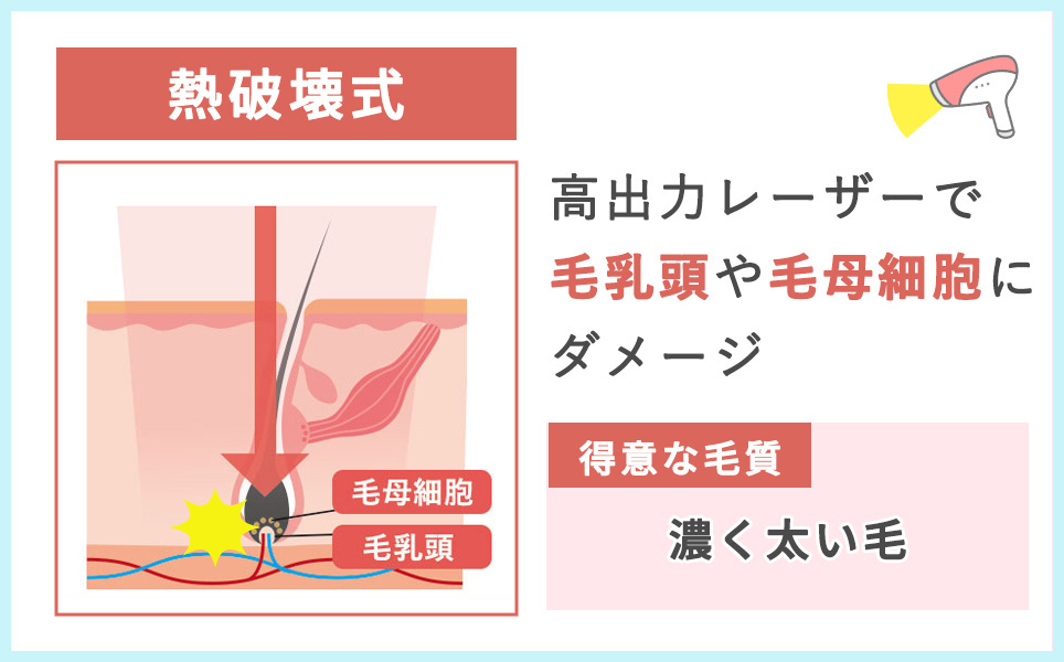 熱は気式脱毛機の特徴まとめ