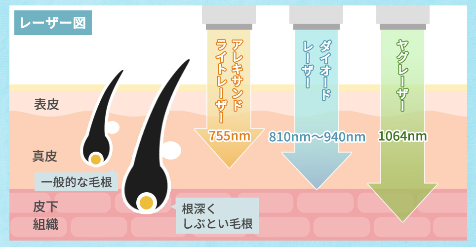 レーザーの違い