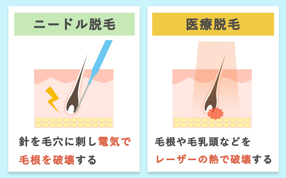 レーザー脱毛とニードル脱毛