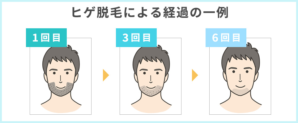 ヒゲ脱毛による経過の一例の図説