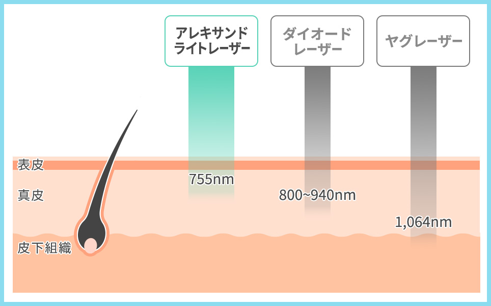 アレキサンドライトレーザーの図説