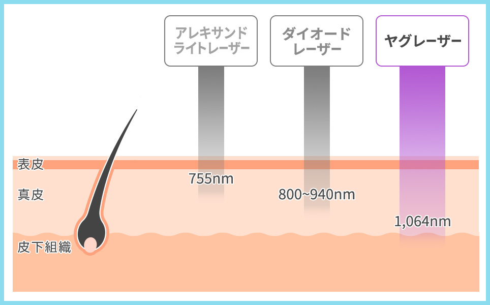 ヤグレーザーの図説