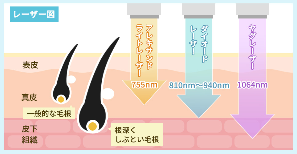 医療脱毛の３つのレーザーの図説