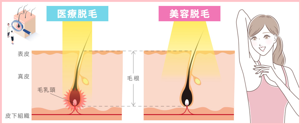 医療脱毛と美容脱毛の脱毛方式の違い