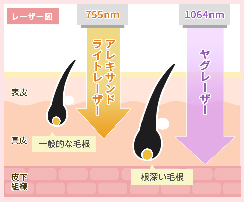 レーザーの種類