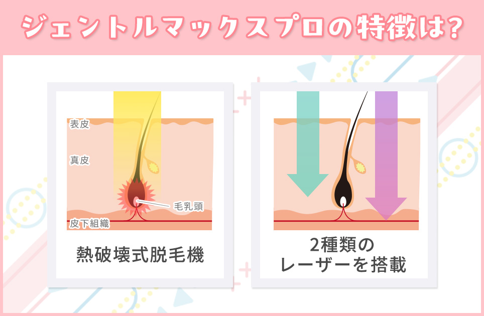 ジェントルマックスプロの特徴は？