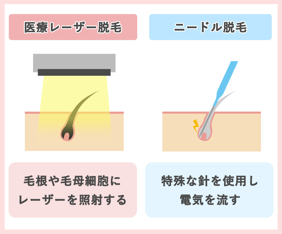 脱毛の違い