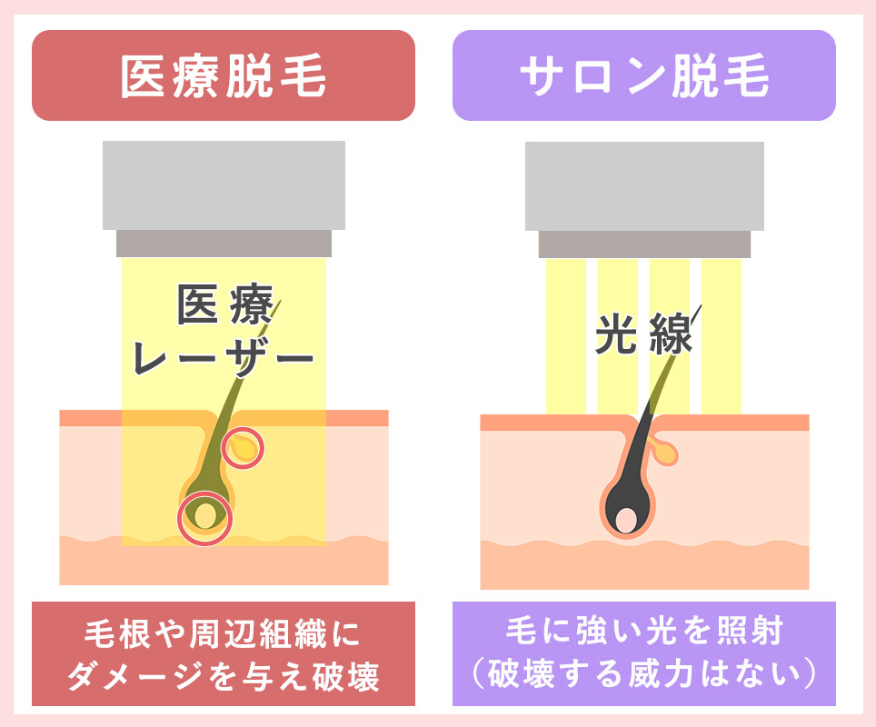 医療脱毛とサロン脱毛の違い