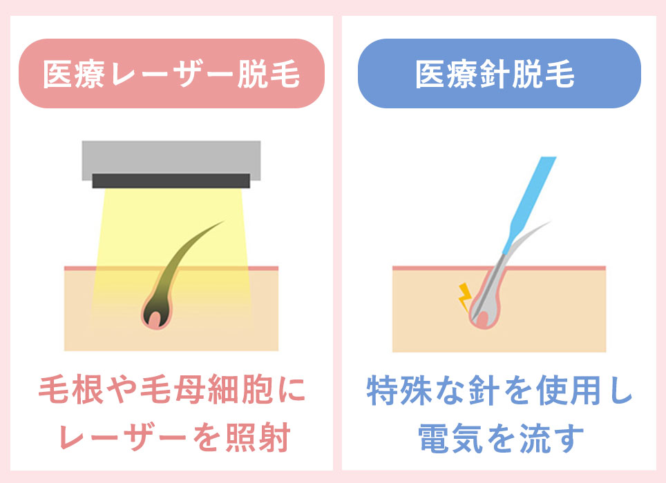 永久脱毛の違い