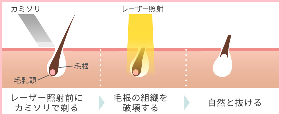 医療レーザー脱毛のしくみ